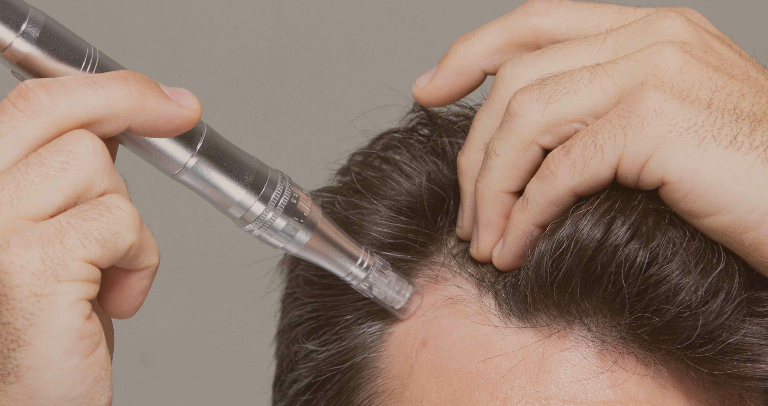 Unlocking Hair Growth Potential: Dr. Pen Microneedling for Scalp Revitalization